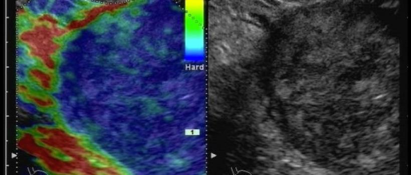 Elastography,  Elastography Market,  Elastography Market Growth,  Elastography Market Share,  Elastography Market Size