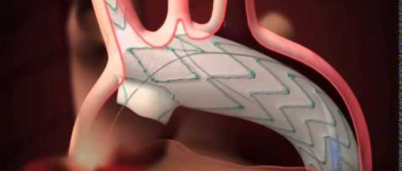 Endovascular Stent Graft