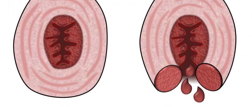 Fecal Incontinence Market