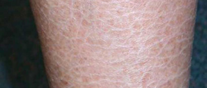 Fish Skin Disease Market