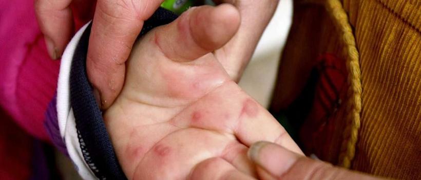 Foot and Mouth Disease Vaccine