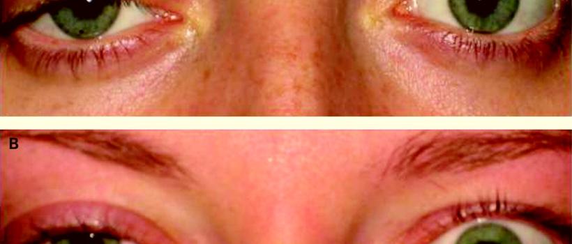 Global Allan-Herndon-Dudley Syndrome Treatment 