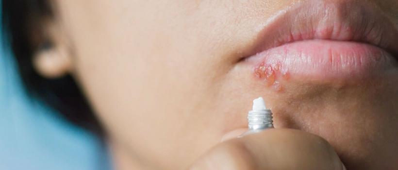 Herpes Simplex Virus Treatment market