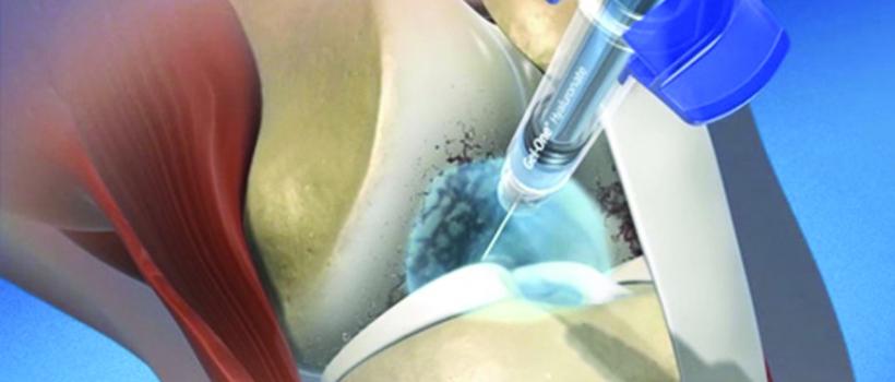 Hyaluronic Acid Viscosupplementation Market