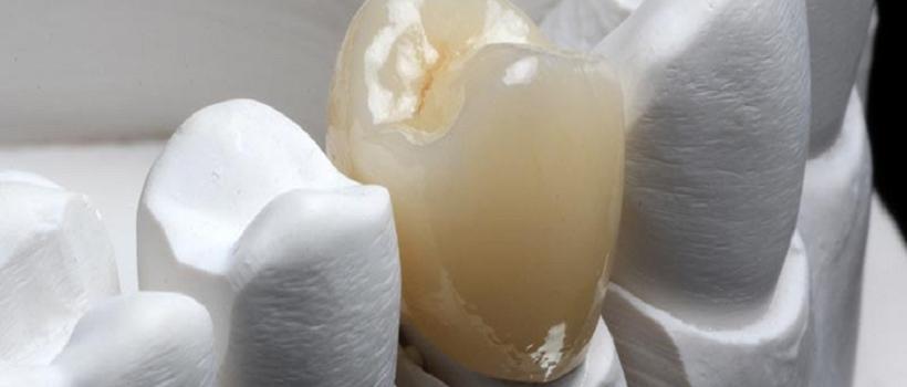 Hybrid-Ceramic Dental CAD/CAM Material, Hybrid-Ceramic Dental CAD/CAM Material Market, Hybrid-Ceramic Dental CAD/CAM Material Market Growth