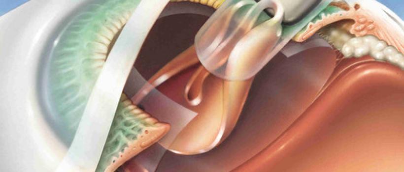 Intraocular Lens Market
