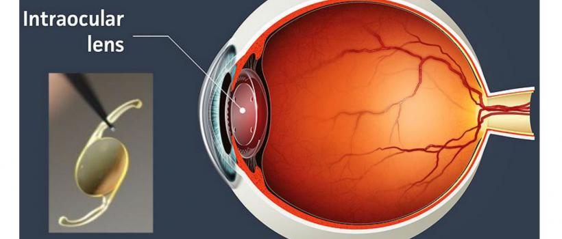  Soft Intraocular Lens Market
