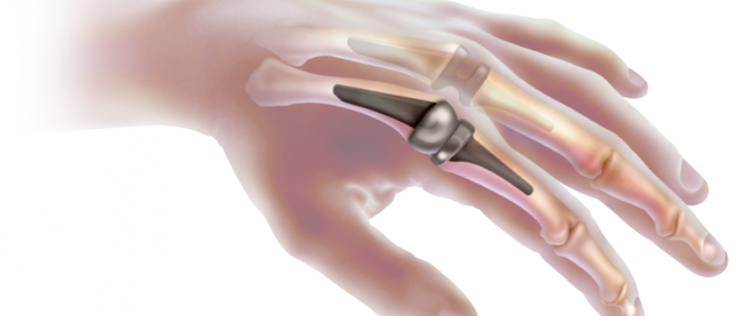 Joint Replacement and Reconstruction Product Industry