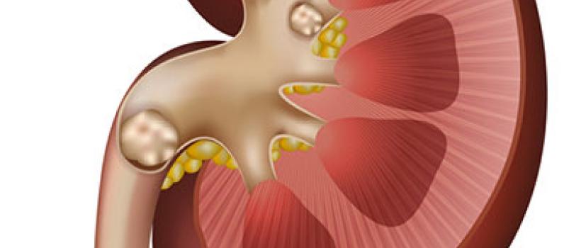Kidney Stones