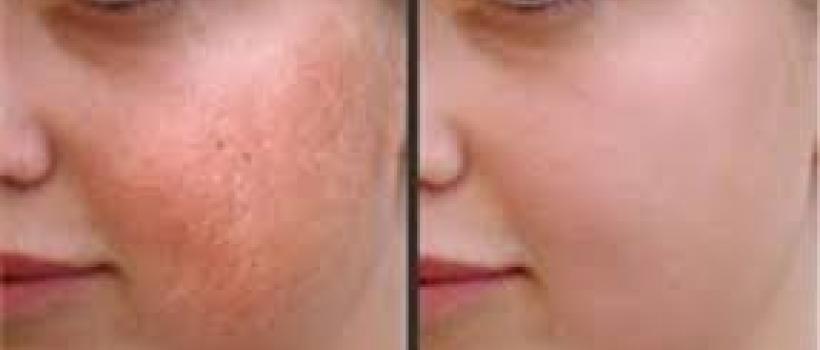 Keloid Treatment Market