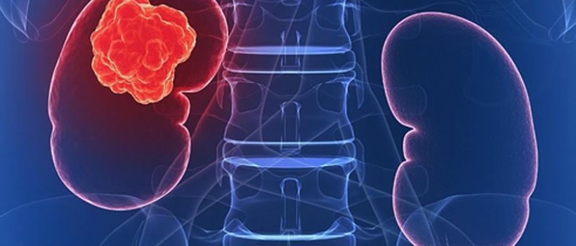 Kidney Cancer Drug Market