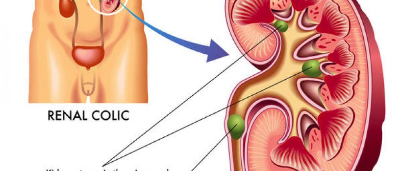 Kidney Stone Doctor In Delhi NCR