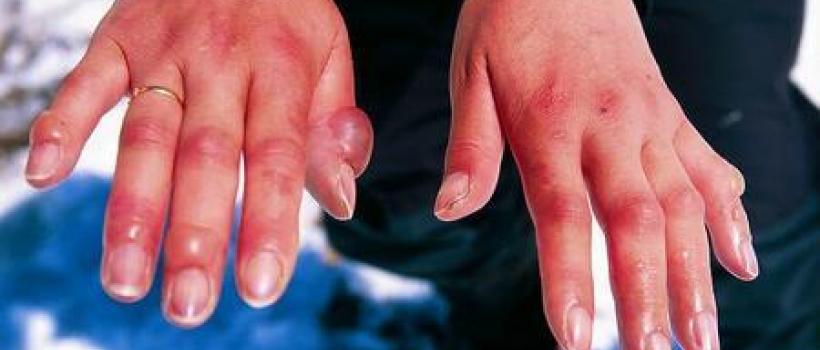 Leprosy treatment Market 