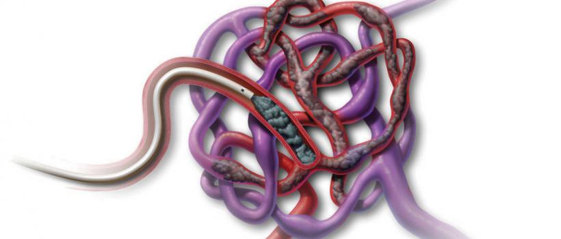 Liquid Embolics 
