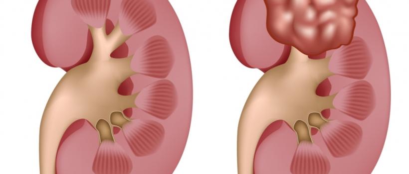 Global Kidney Cancer Diagnostics and Therapeutics