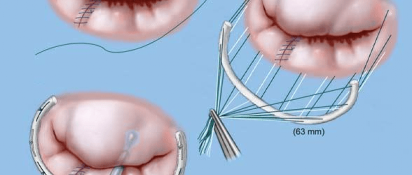 Mitral Valve Annuloplasty Rings Market
