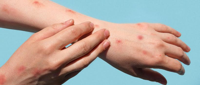 Monkeypox Treatment Market