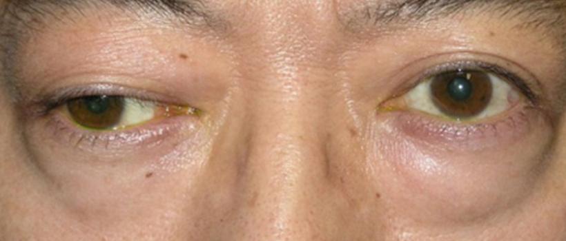 Myasthenia Gravis Market