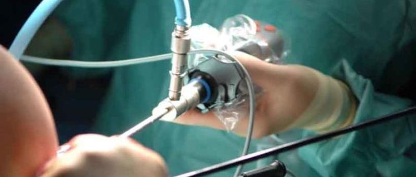 Myomectomy