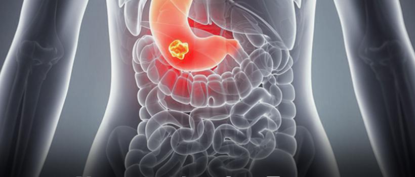Neuroendocrine Tumor Treatment Market 