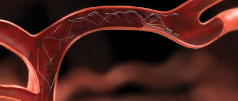 Neurovascular Devices/Interventional Neurology Market
