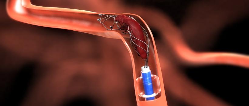 Neurovascular Devices/Interventional Neurology 