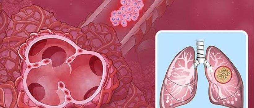 Non-Small Cell Lung Cancer  Market 