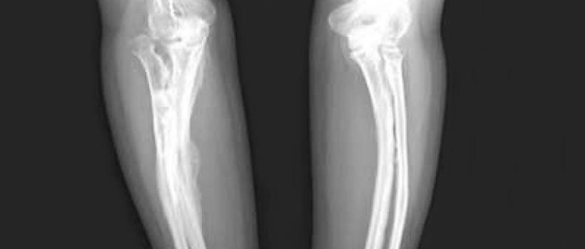 OSTEOGENESIS IMPERFECTA TREATMENT MARKET