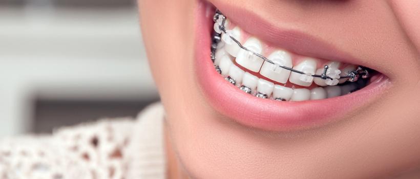 Orthodontic Supplies
