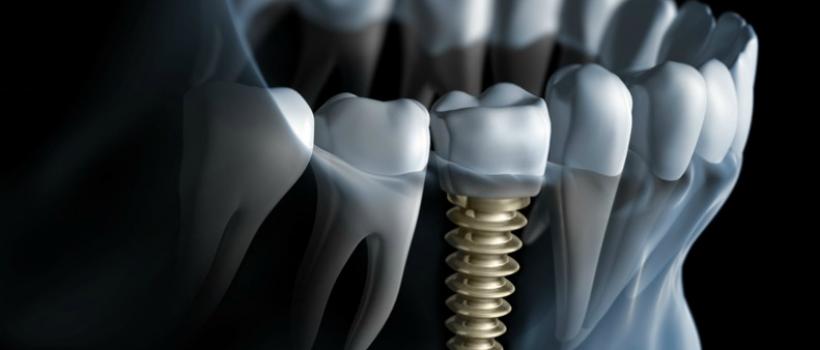 Osseointegration Implants Market