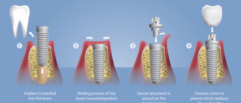 Osseointegration Implants Market