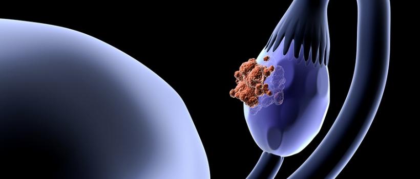 Ovarian Cancer Treatment Doctors Mumbai