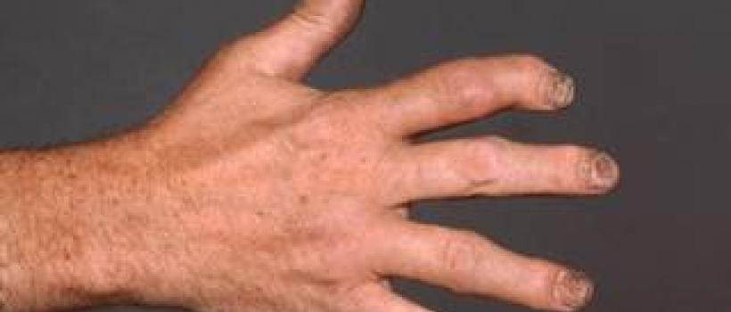 ArthritisTreatmentCenterNagpur