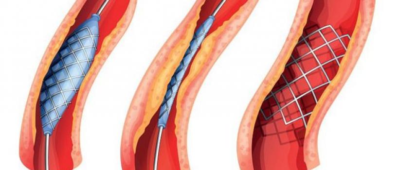 Peripheral Vascular Devices