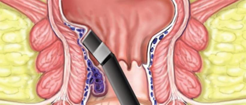 Piles Fistula Laser Treatment