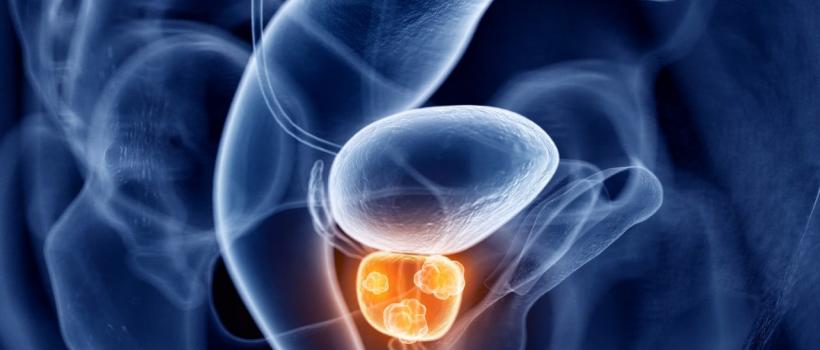  Prostate Cancer