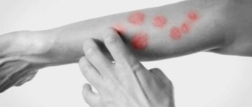 Pruritus Therapeutics Market