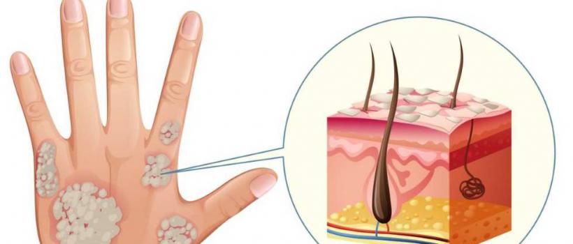 Psoriasis Drugs Market Size 
