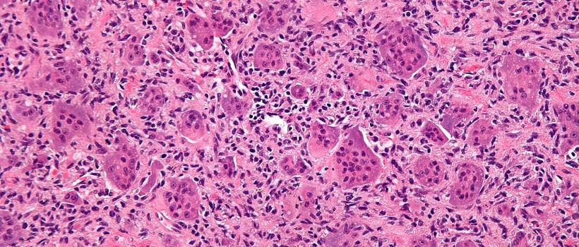 Relapsed or Refractory Diffuse Large B-cell Lymphoma