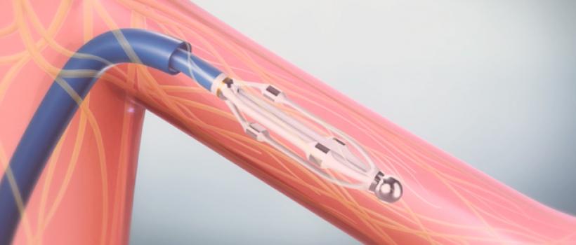 Renal Denervation Market
