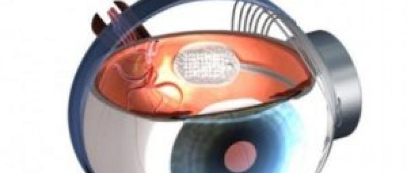 Retinal Implant Market