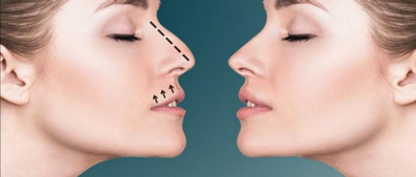 Rhinoplasty Market