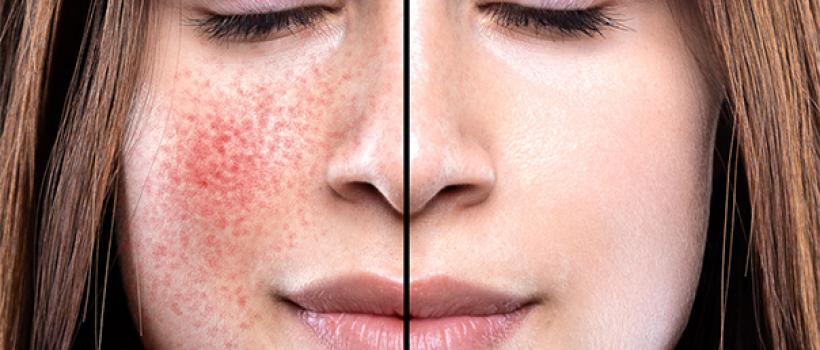 Rosacea Treatment Market