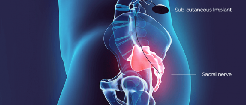 Sacral Nerve Stimulators Sales
