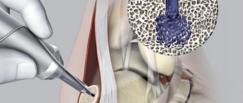 Soft Tissue Repair Market