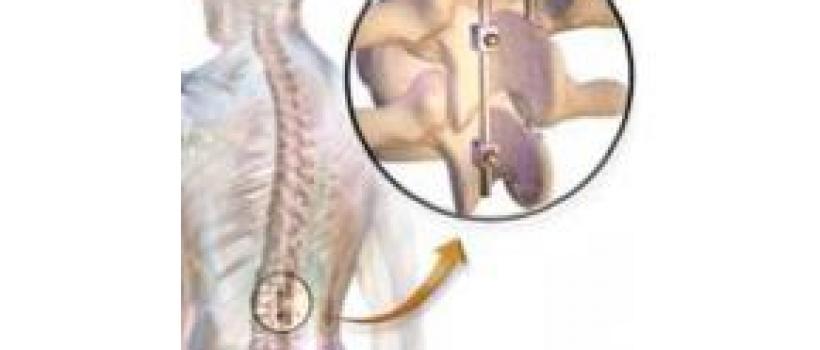 Spinal Fusion