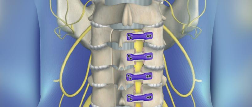  Spinal Laminoplasty Market 