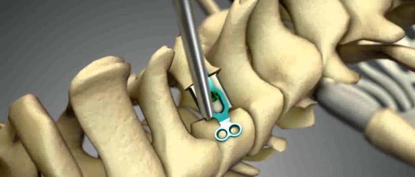 Global Spinal Laminoplast