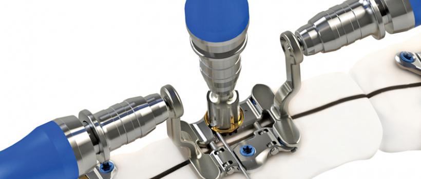 Sternal Closure Systems Market