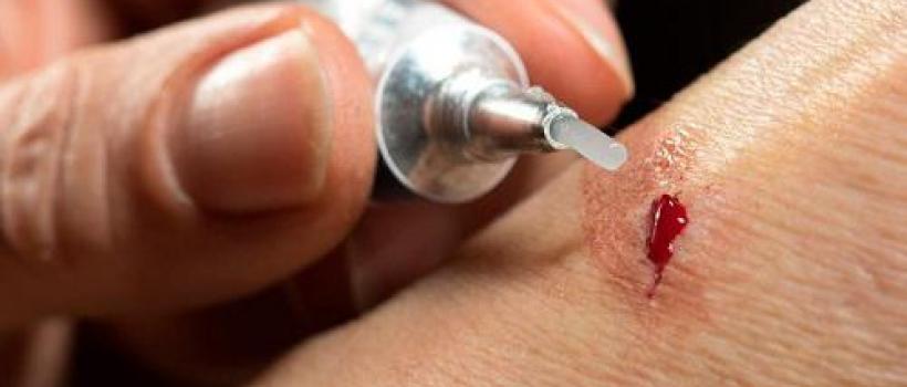 Surgical Glue Market